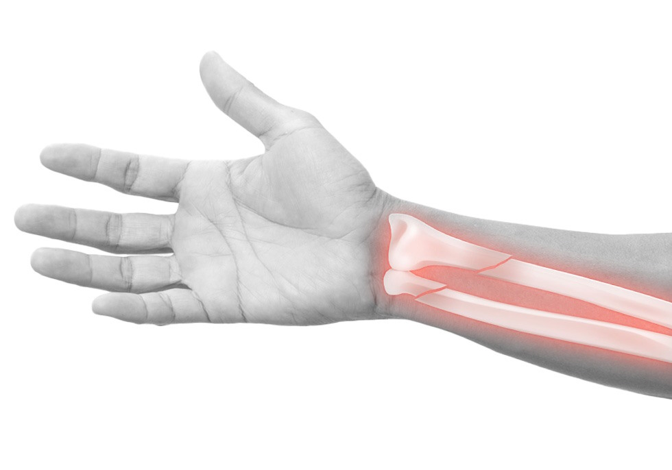 Fisioterapia especializada en fracturas de hueso Fisioterapia especializada en fracturas de hueso